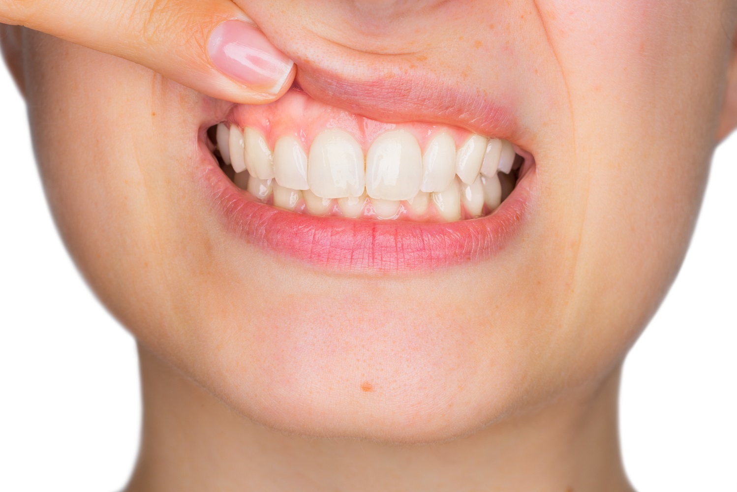 Receding Gums Dentist in Sugarland TX 1000px