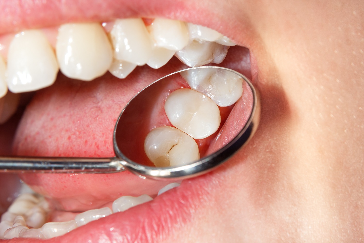 Dental Sealants Dental Care Sugar Land Tx Dentist