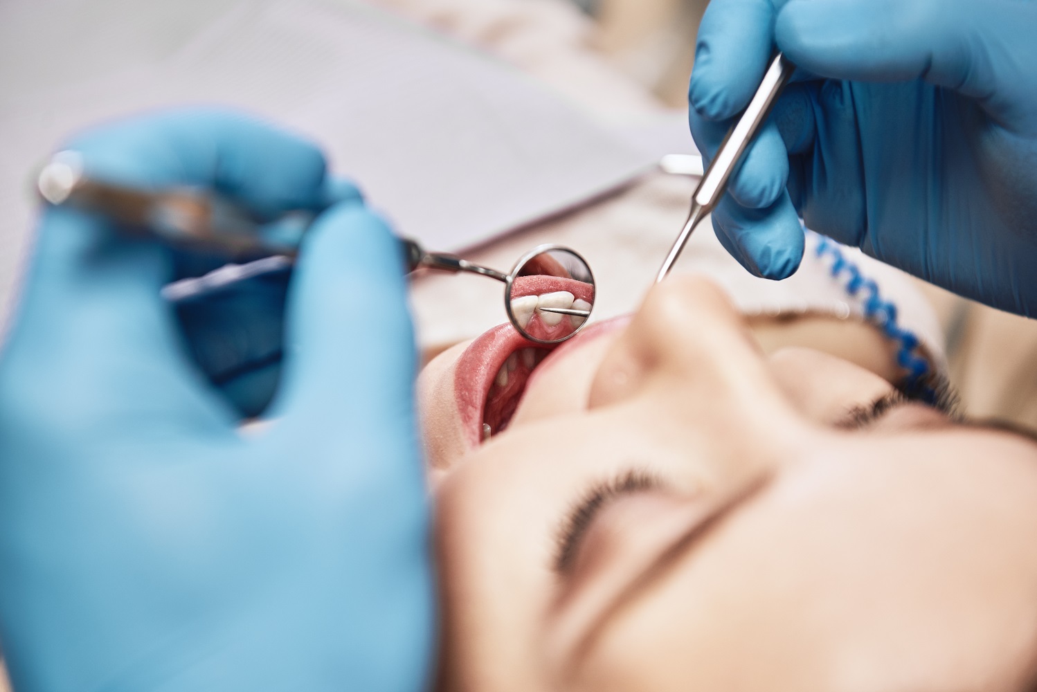 Cracked Teeth Fractured Cusp Dental Hygiene Dentist in Sugarland TX
