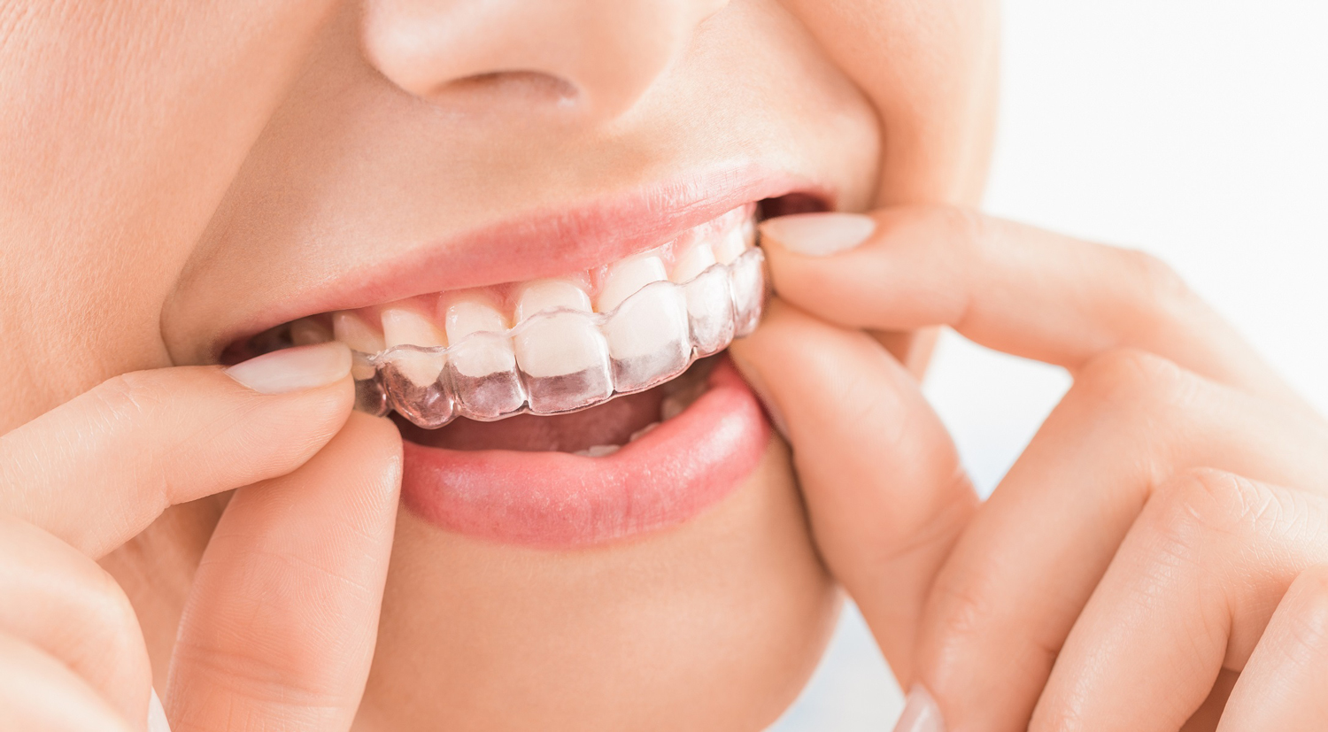 Mouthguard nightguard dentalhygiene dentistinsugarlandtx