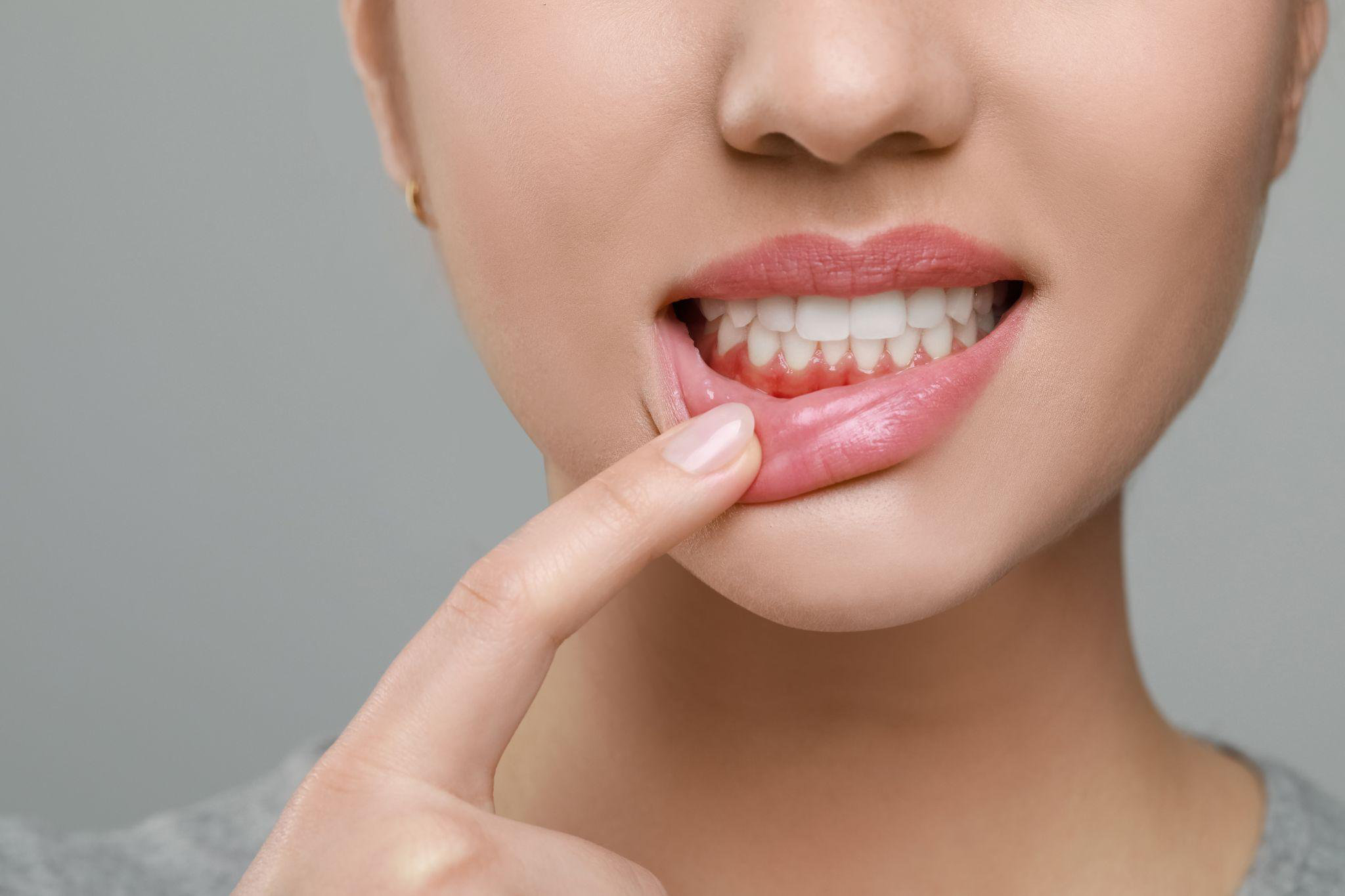 Gingivitis to Gum Disease